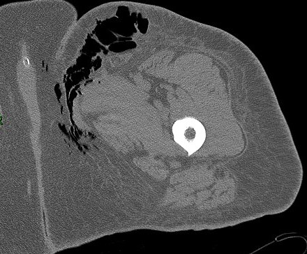 Figure 1 for case Necrotizing fasciitis ( RID3447 )